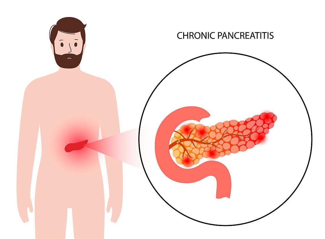 Chronic pancreatitis, illustration