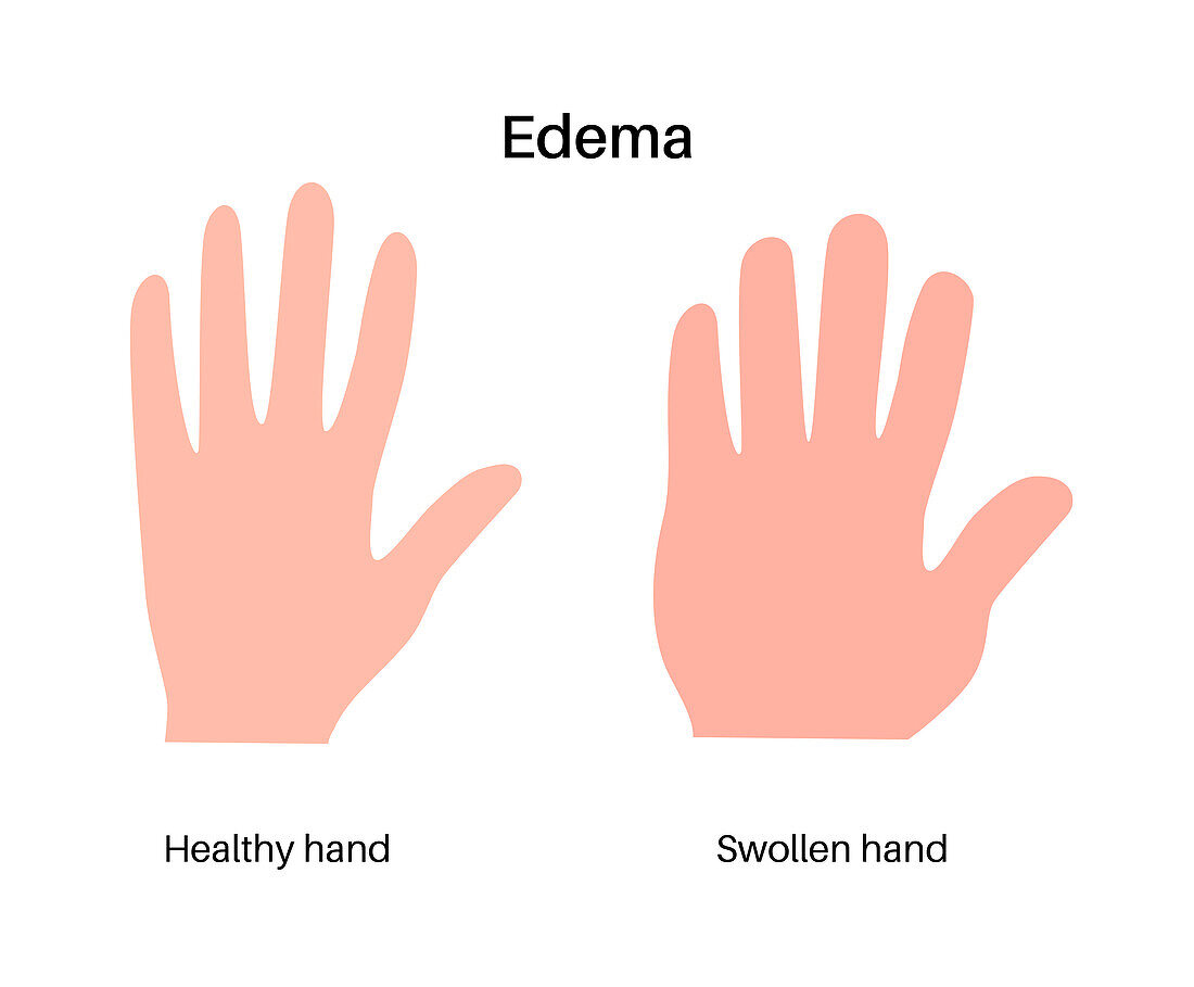 Oedema of arm, illustration