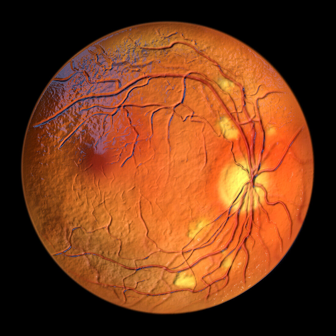 Retina damage from diabetes, illustration