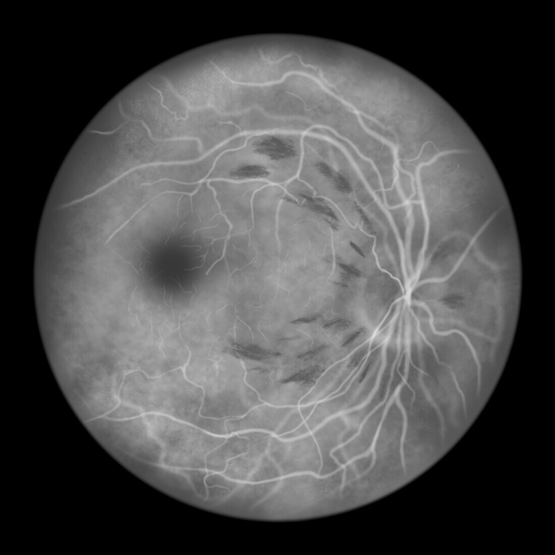 Retina damage from diabetes, illustration