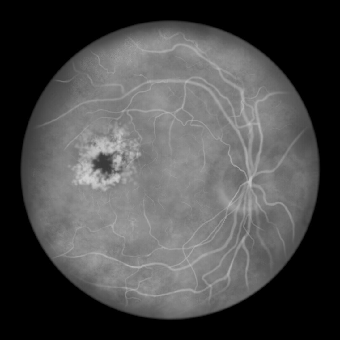 Retina damage from diabetes, illustration