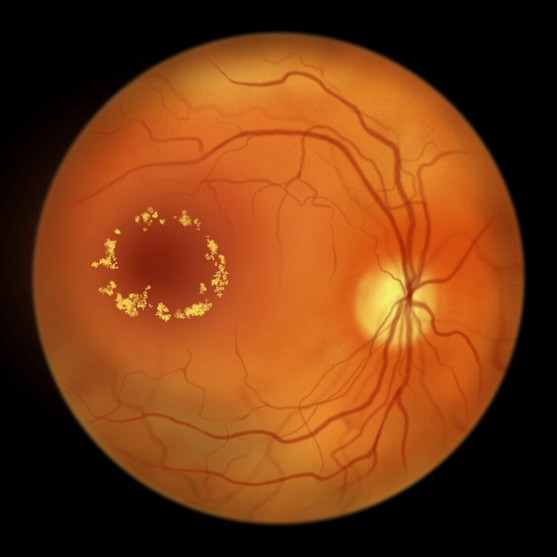 Retina damage from diabetes, illustration