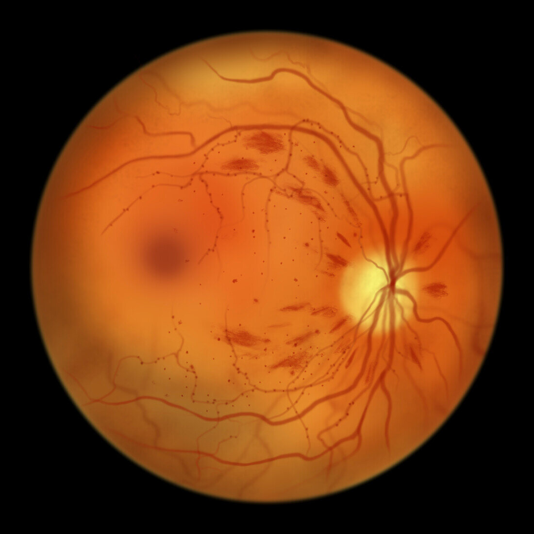 Retina damage from diabetes, illustration