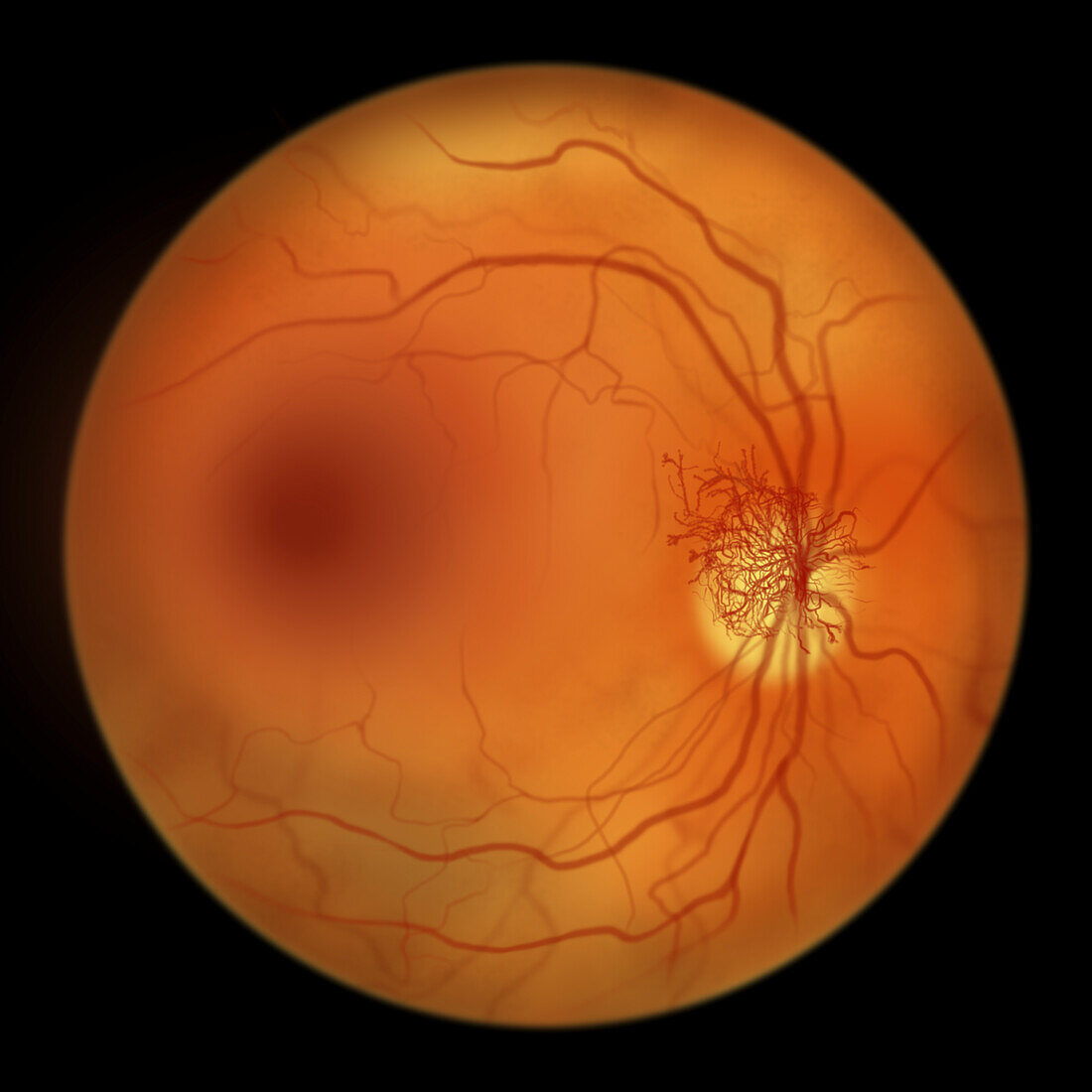 Retina damage from diabetes, illustration