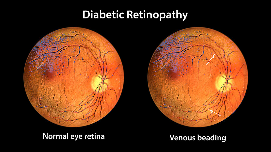 Retina damage from diabetes, illustration