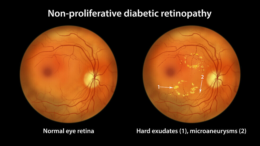 Retina damage from diabetes, illustration