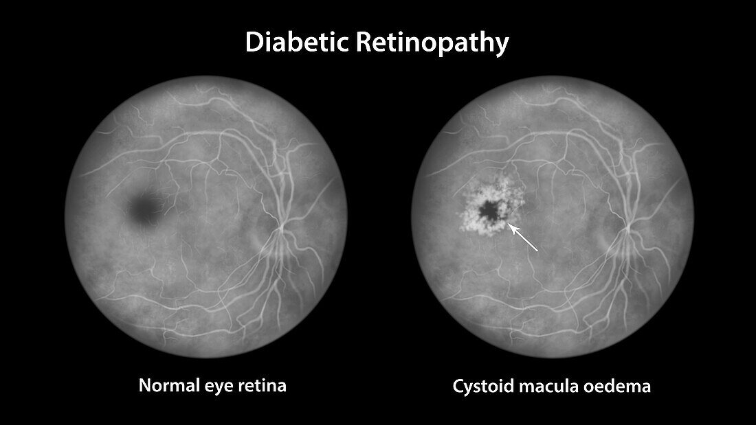 Retina damage from diabetes, illustration