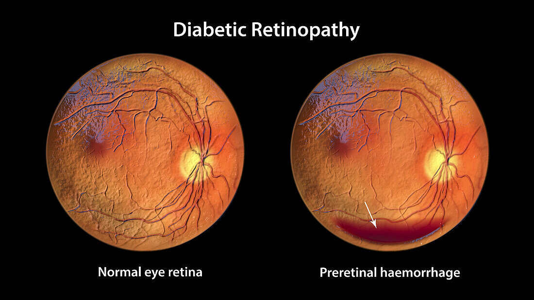 Retina damage from diabetes, illustration