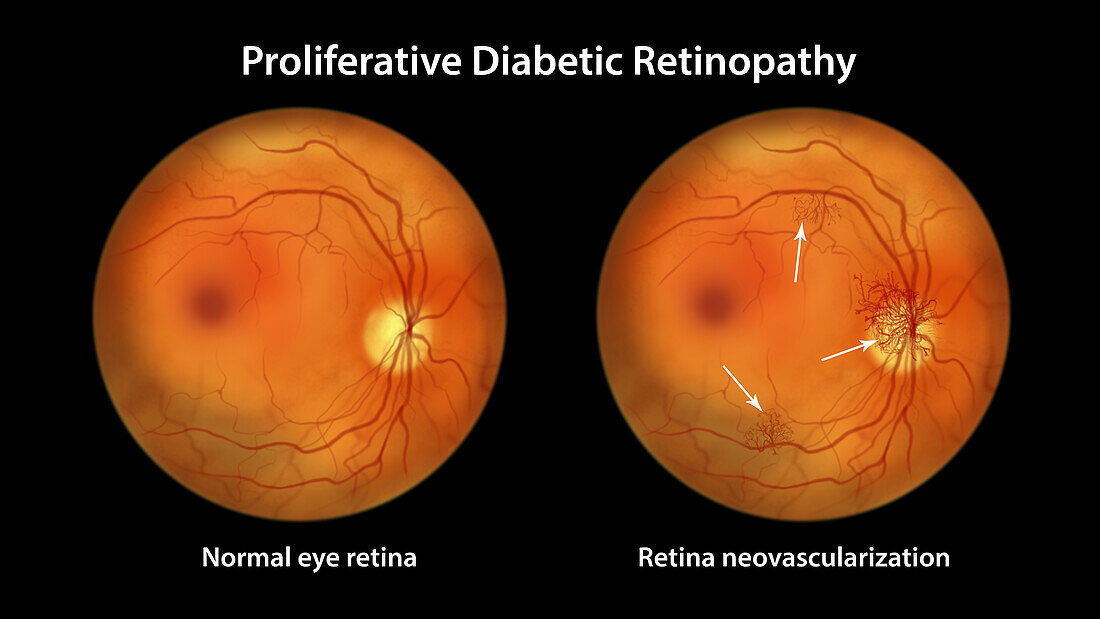 Retina damage from diabetes, illustration