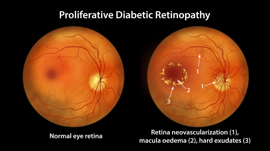 Retina damage from diabetes, illustration