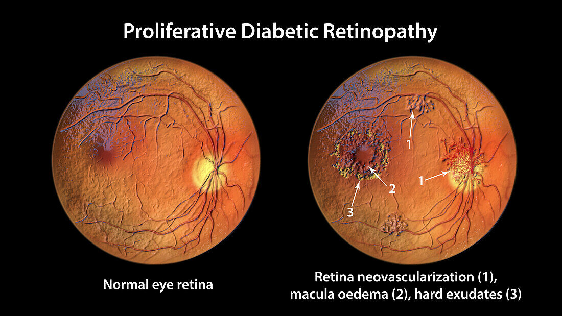 Retina damage from diabetes, illustration