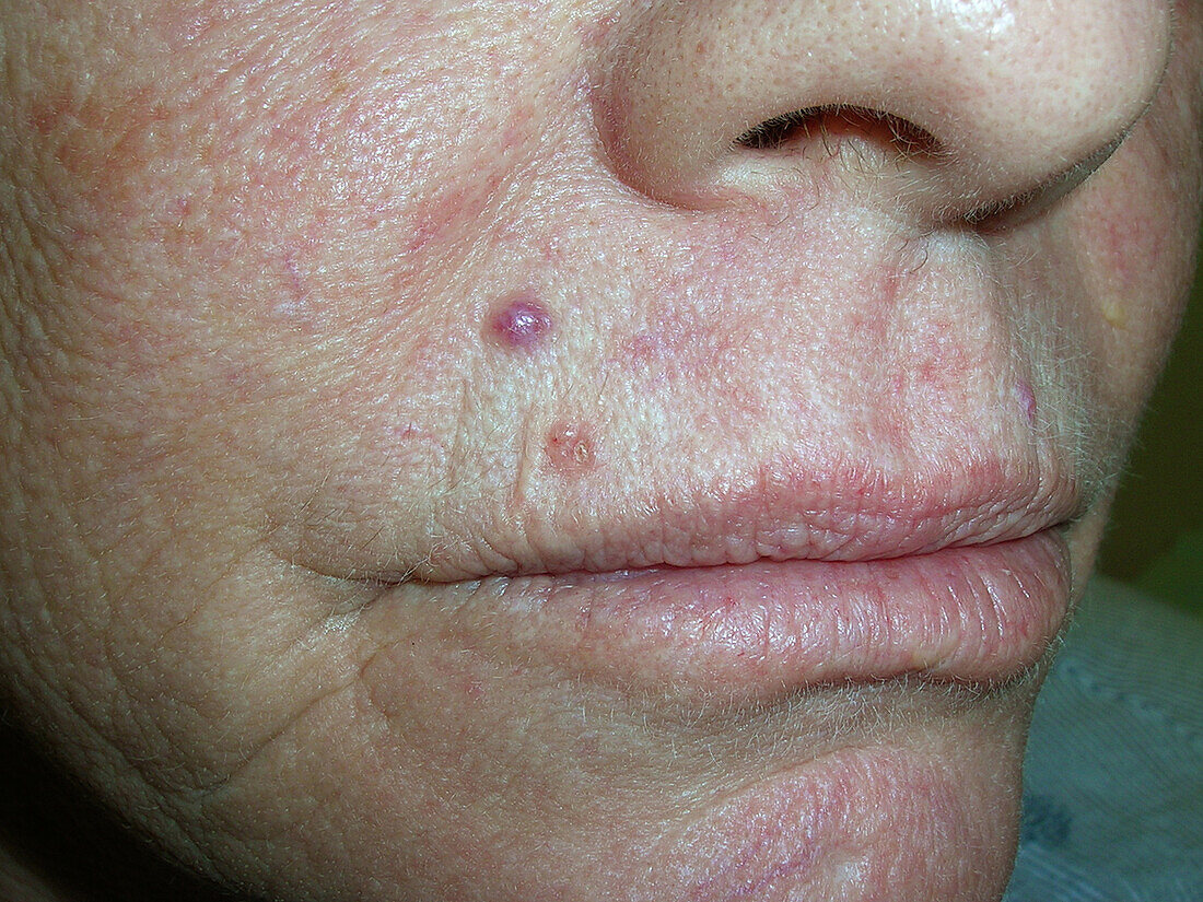 Basal cell carcinoma