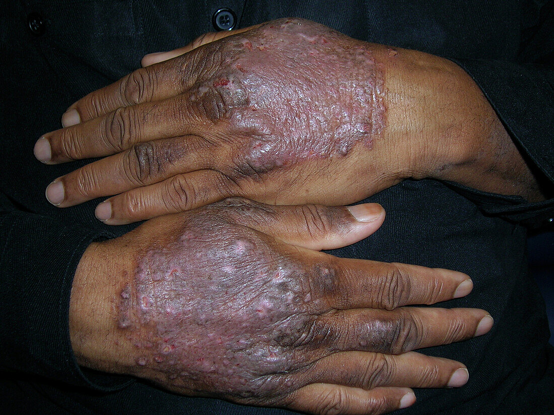 Lichen simplex chronicus