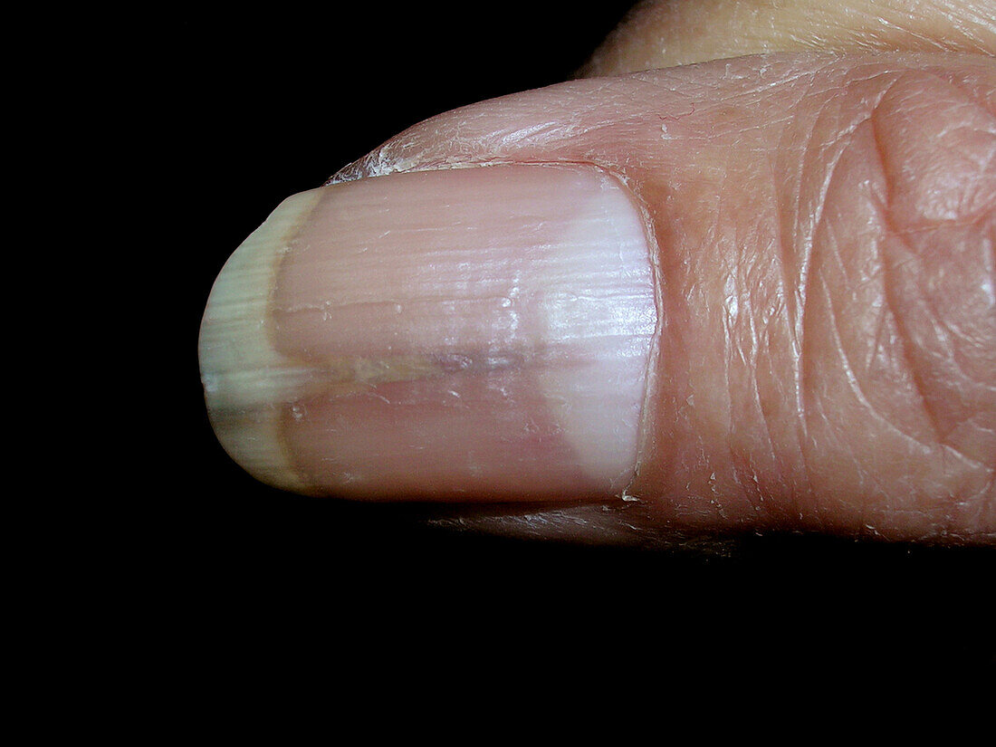 Median nail dystrophy on a patient's fingernails
