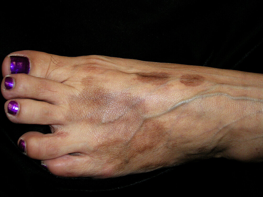 Pigmented purpuric dermatosis