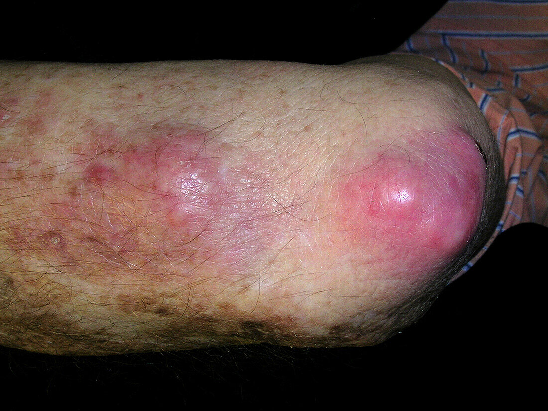 Rheumatoid arthritis nodules