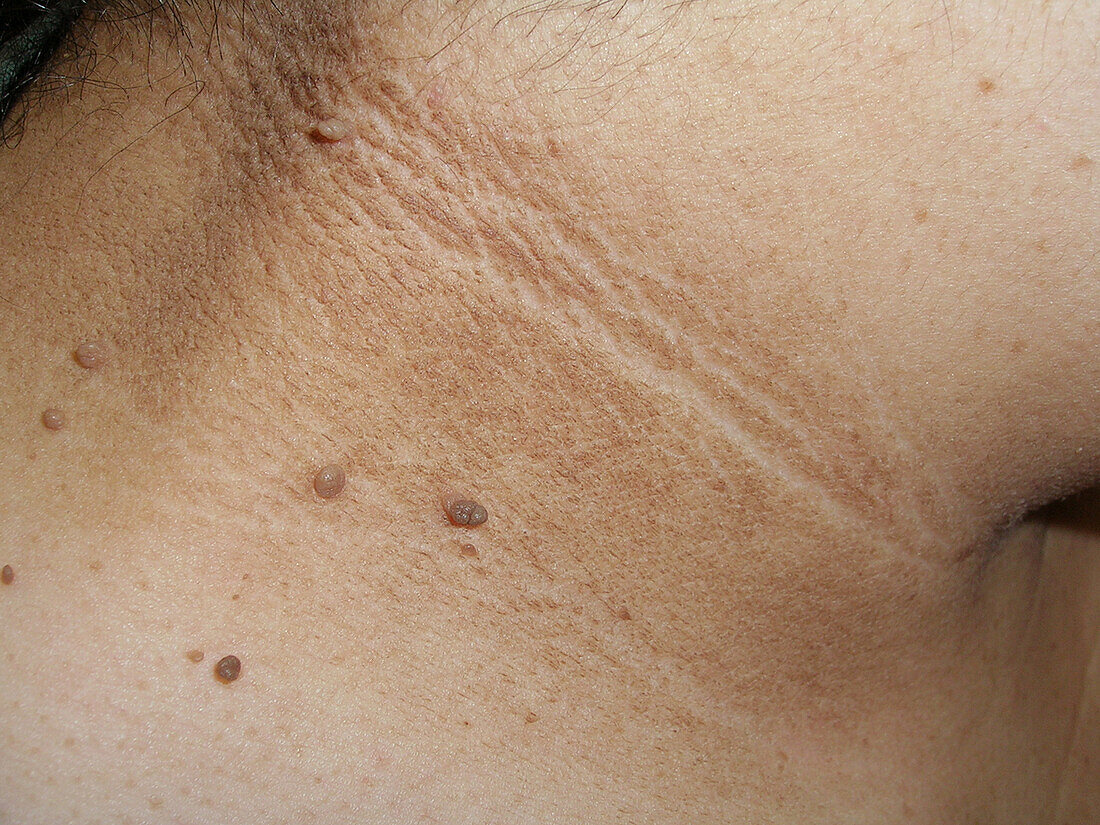 Acanthosis skin tags
