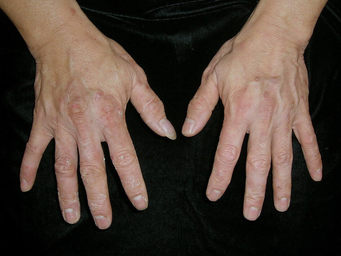 Contact dermatitis