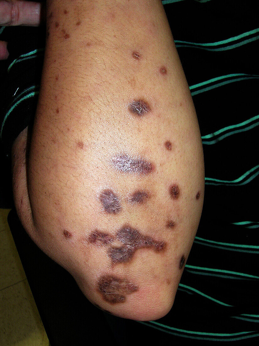 Discoid lupus erythematosus