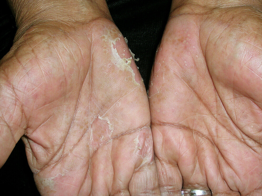 Dyshidrotic eczema