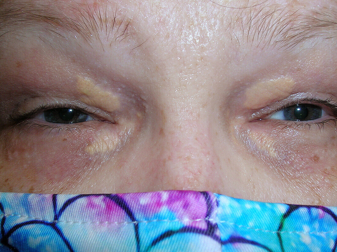 Xanthelasma