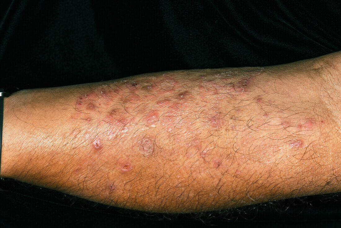 Majocchi's granuloma