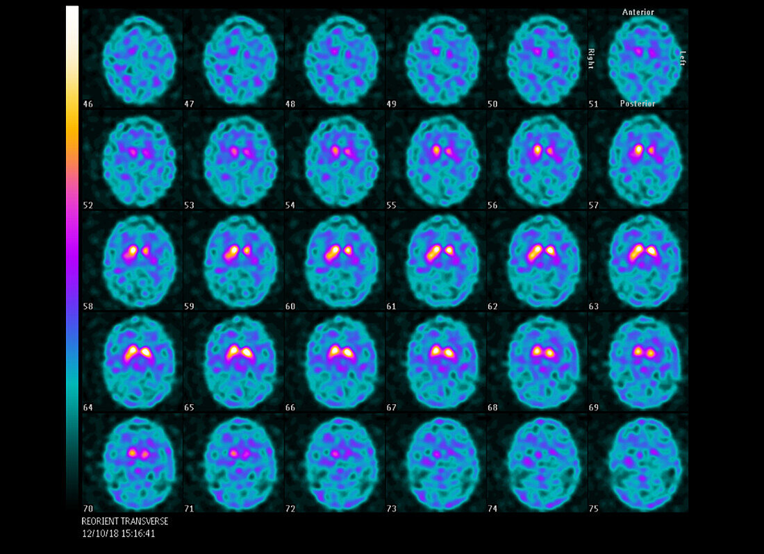 Dopamine transporter-PET brain scans