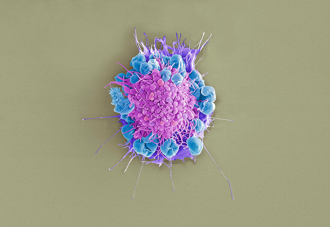 Cervical cancer cell, SEM