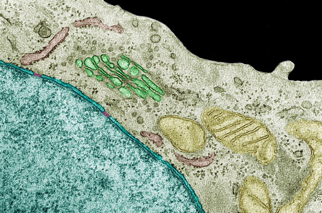 Cervical cancer cell, TEM