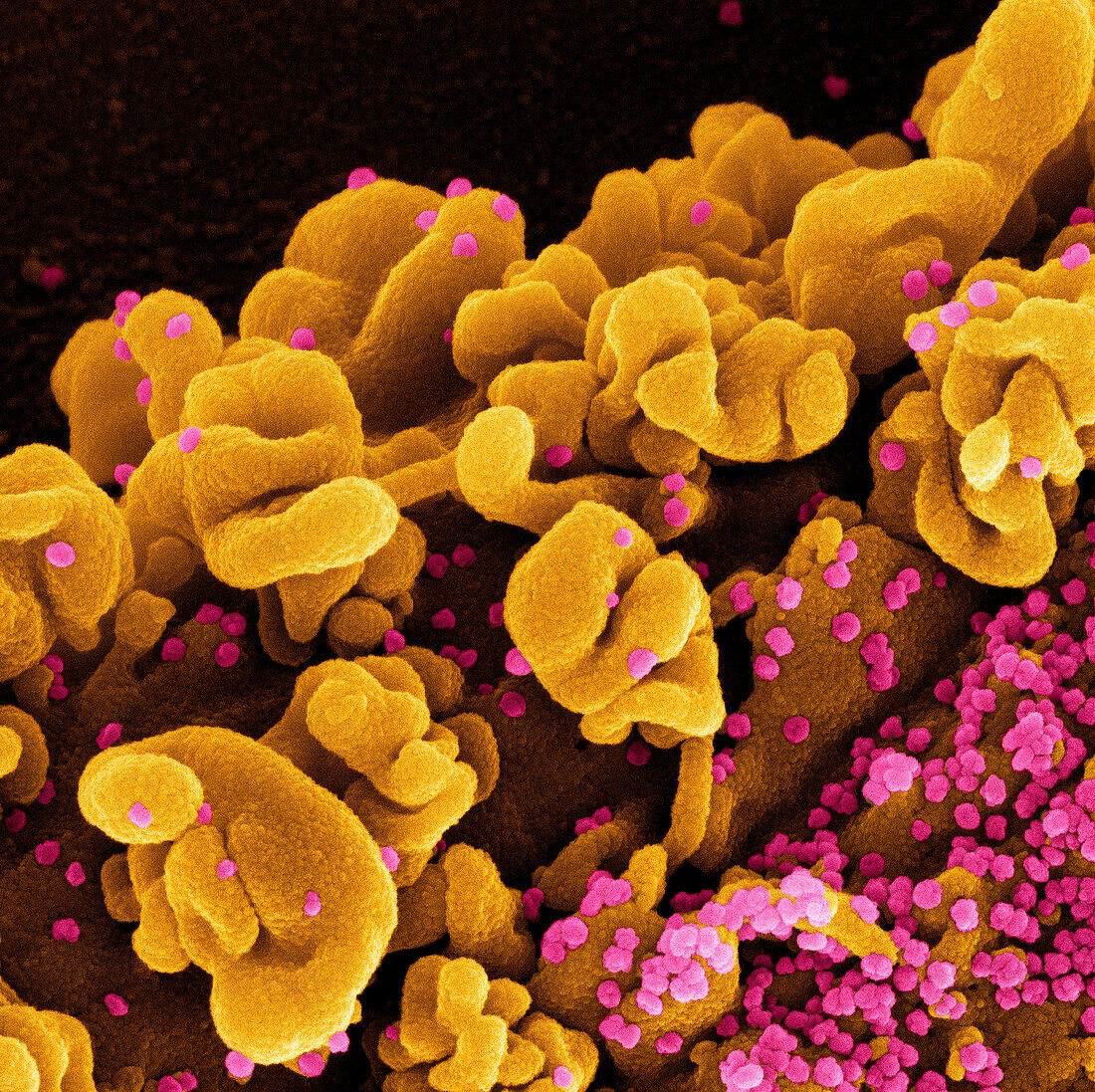 Cell infected by SARS-CoV-2 Omicron virus particles, SEM