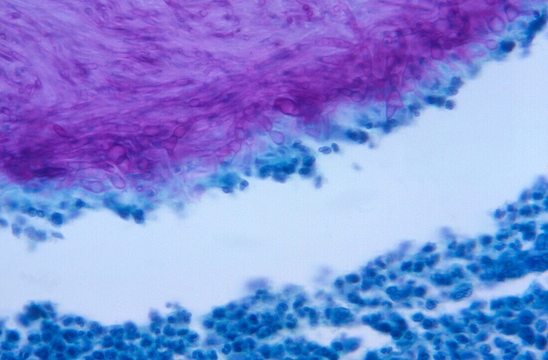 Eumycetoma infected tissue sample, light micrograph