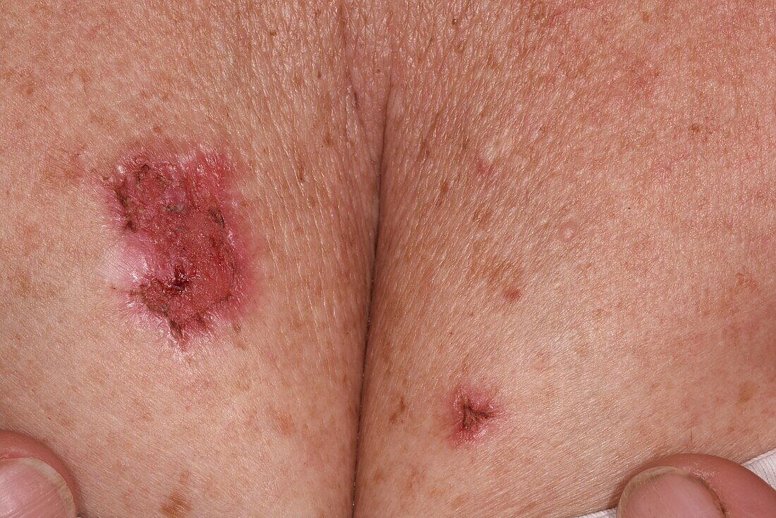 Treatment of superficial basal cell carcinoma