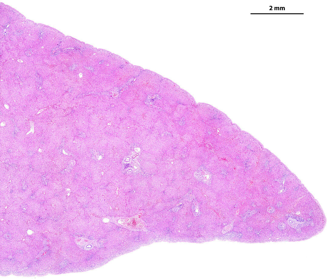 Liver fibrosis, light micrograph
