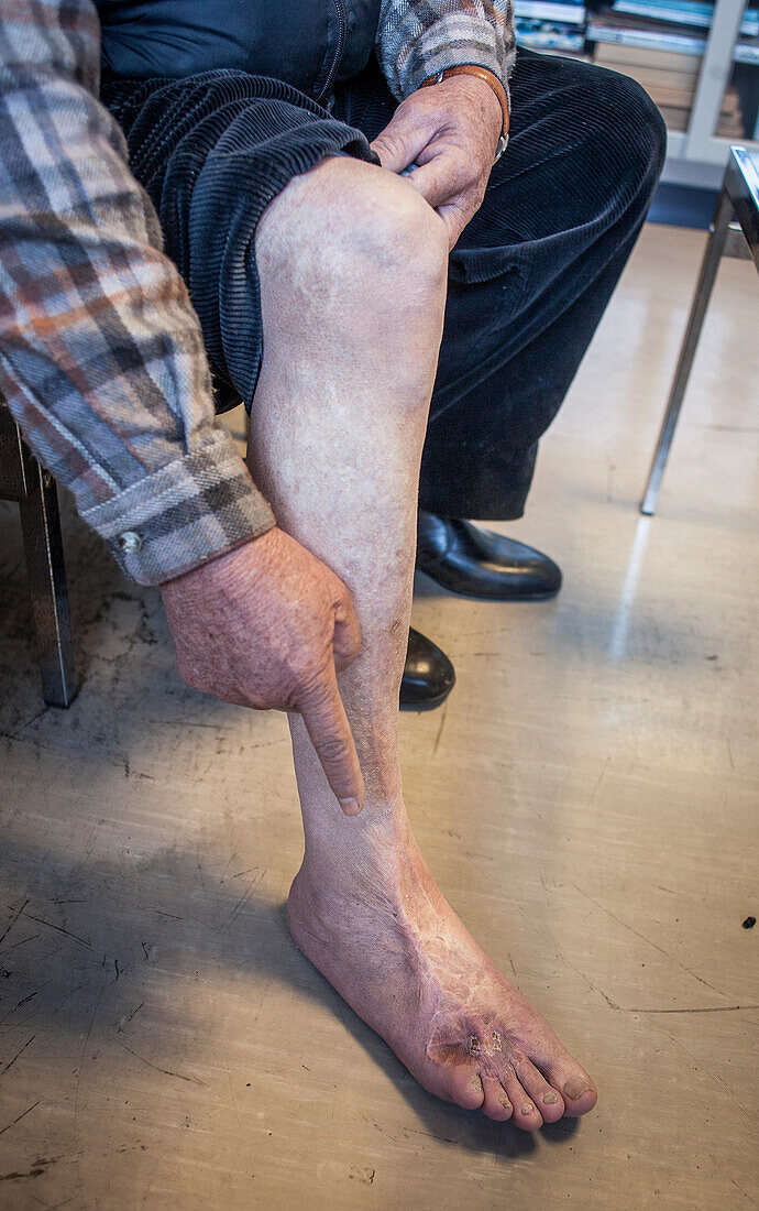 Atomic bomb survivor showing scars