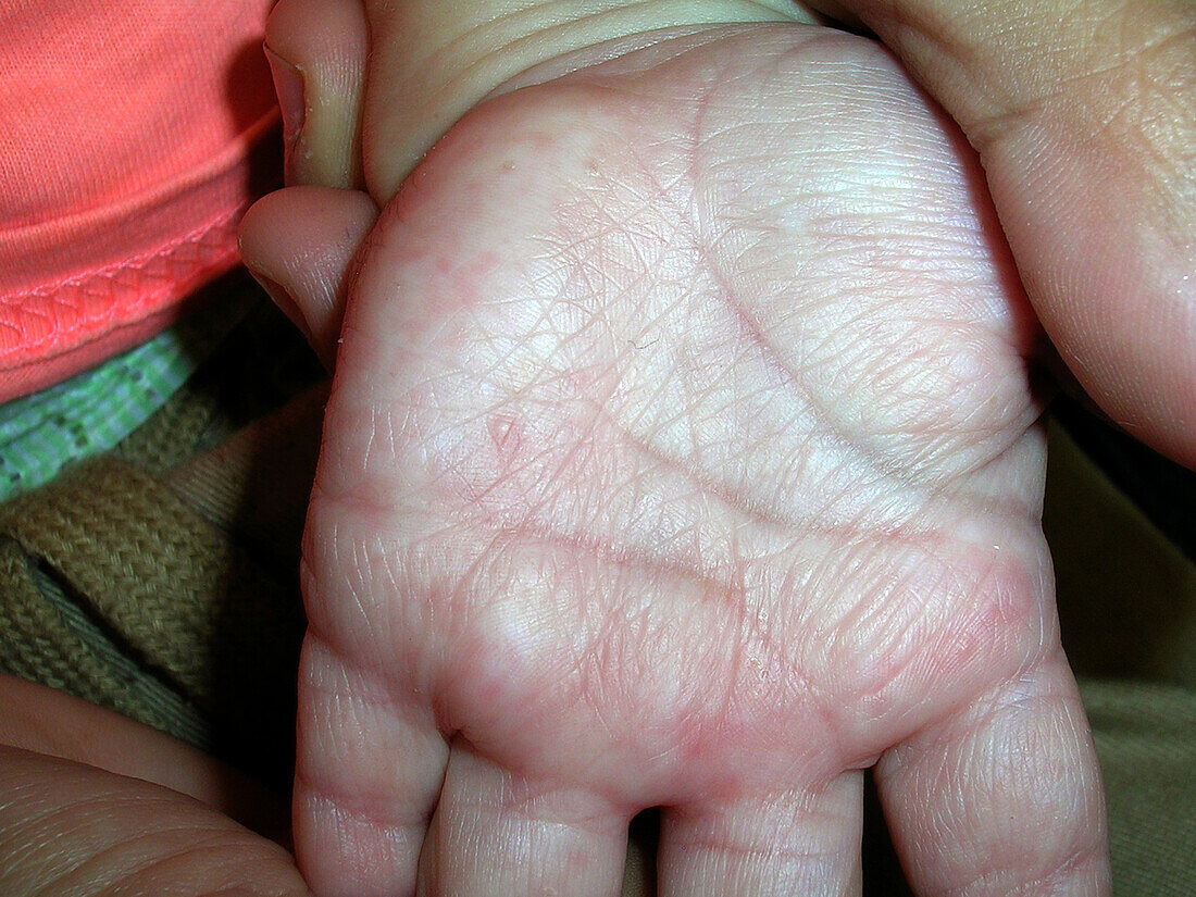 Acropustulosis of infancy