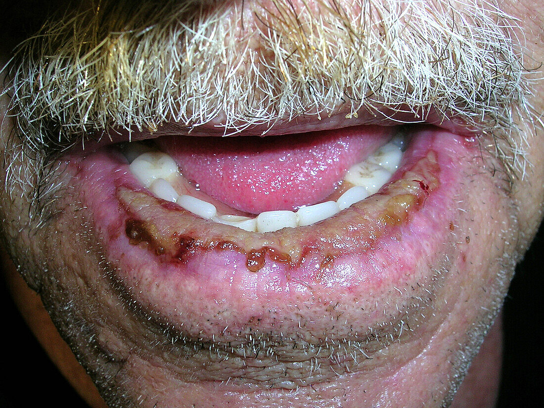 Actinic cheilitis after treatment