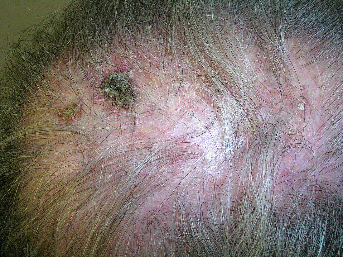 Sun damaged scalp