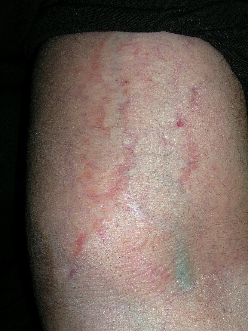 Atopic and seborrhoeic dermatitis