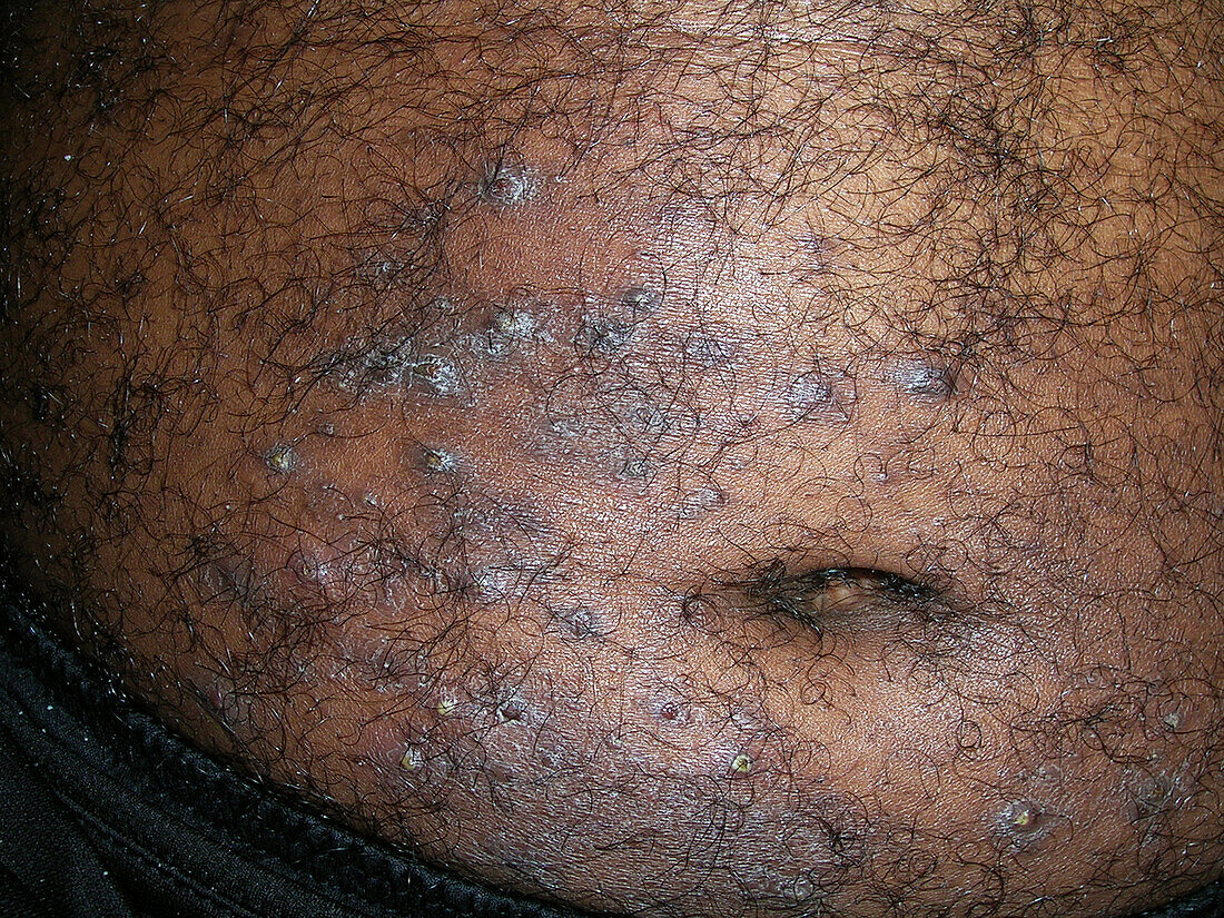 Infected atopic dermatitis