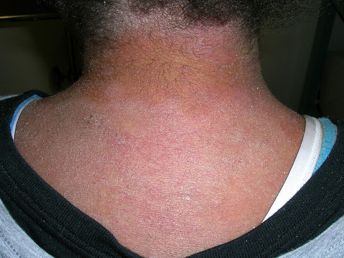Erythrodermic atopic dermatitis