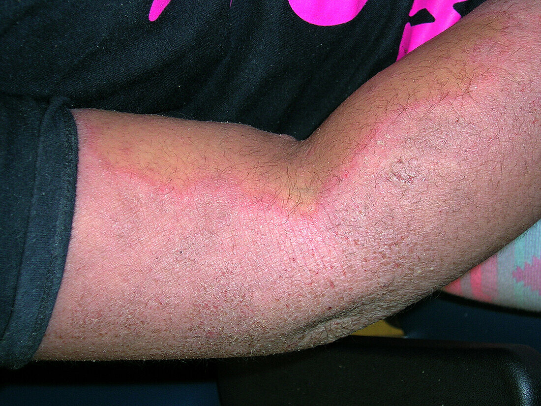 Erythrodermic atopic dermatitis