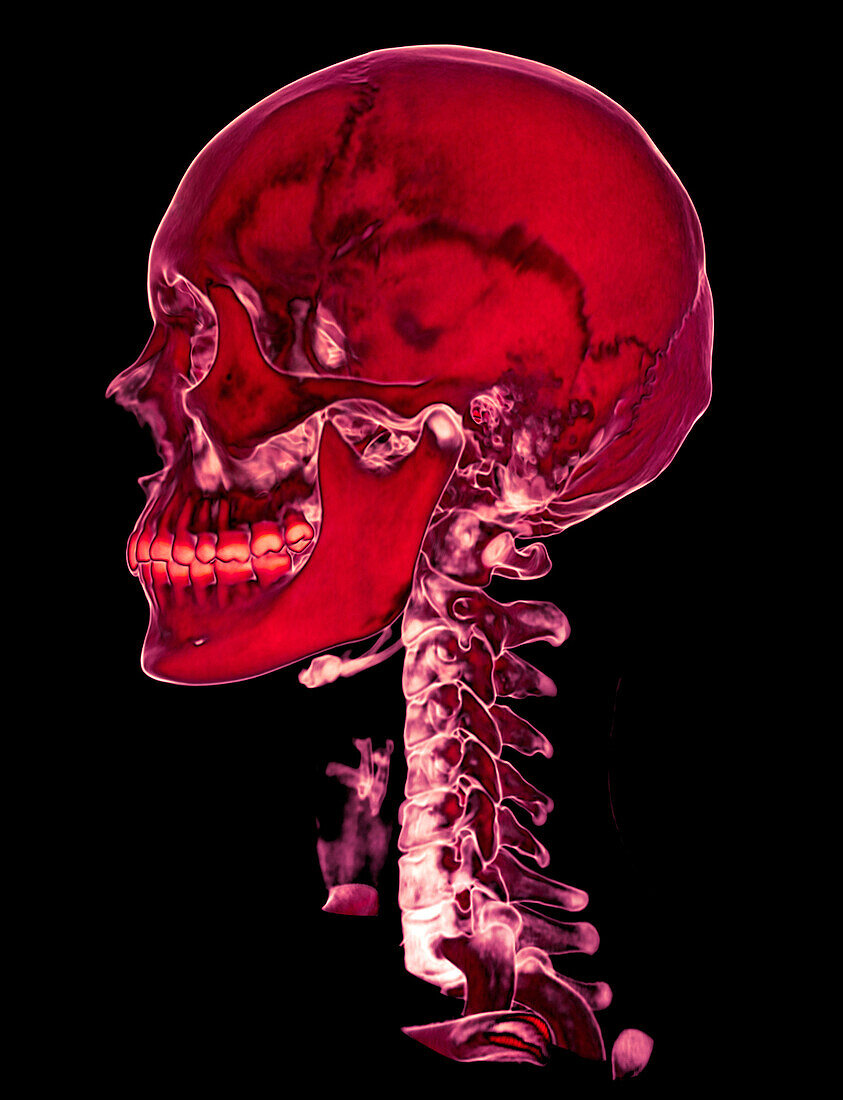 Bones of the skull and neck, CT scan