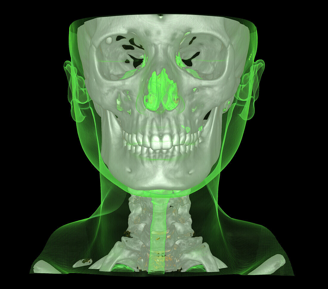 Skull and neck, CT scan