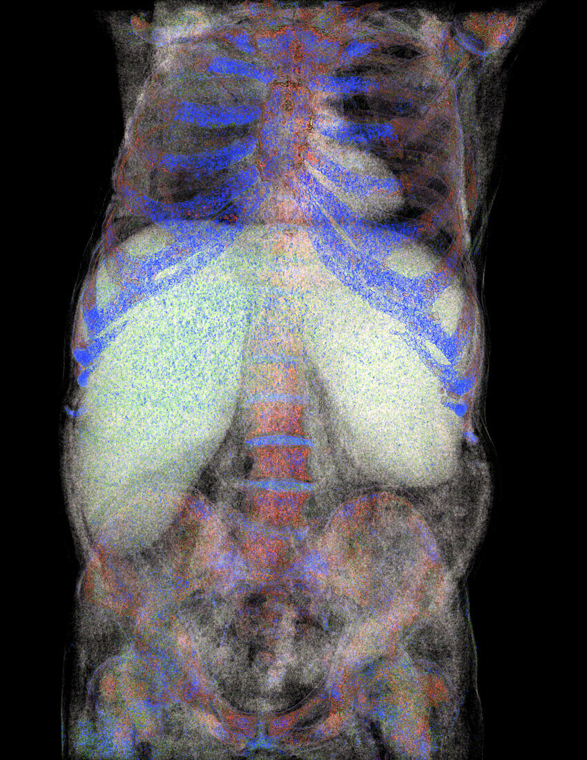 Hepatosplenomegaly, CT scan