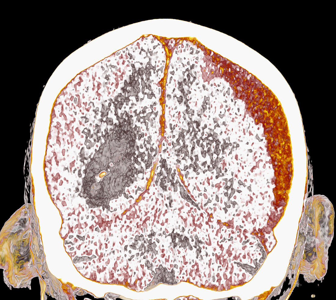 Subdural haemorrhage, CT scan