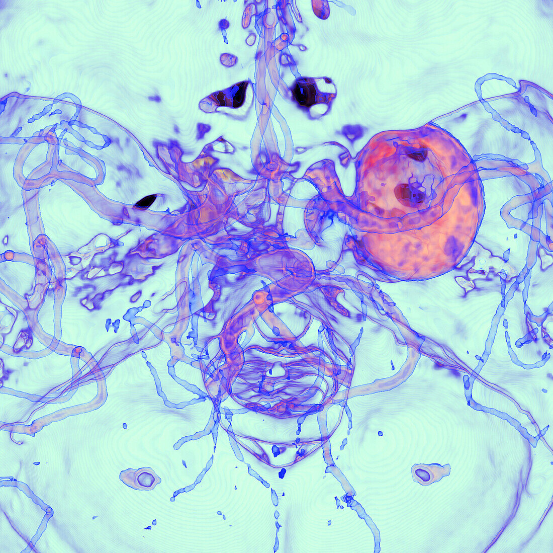 Intracranial aneurysm, CT angiography