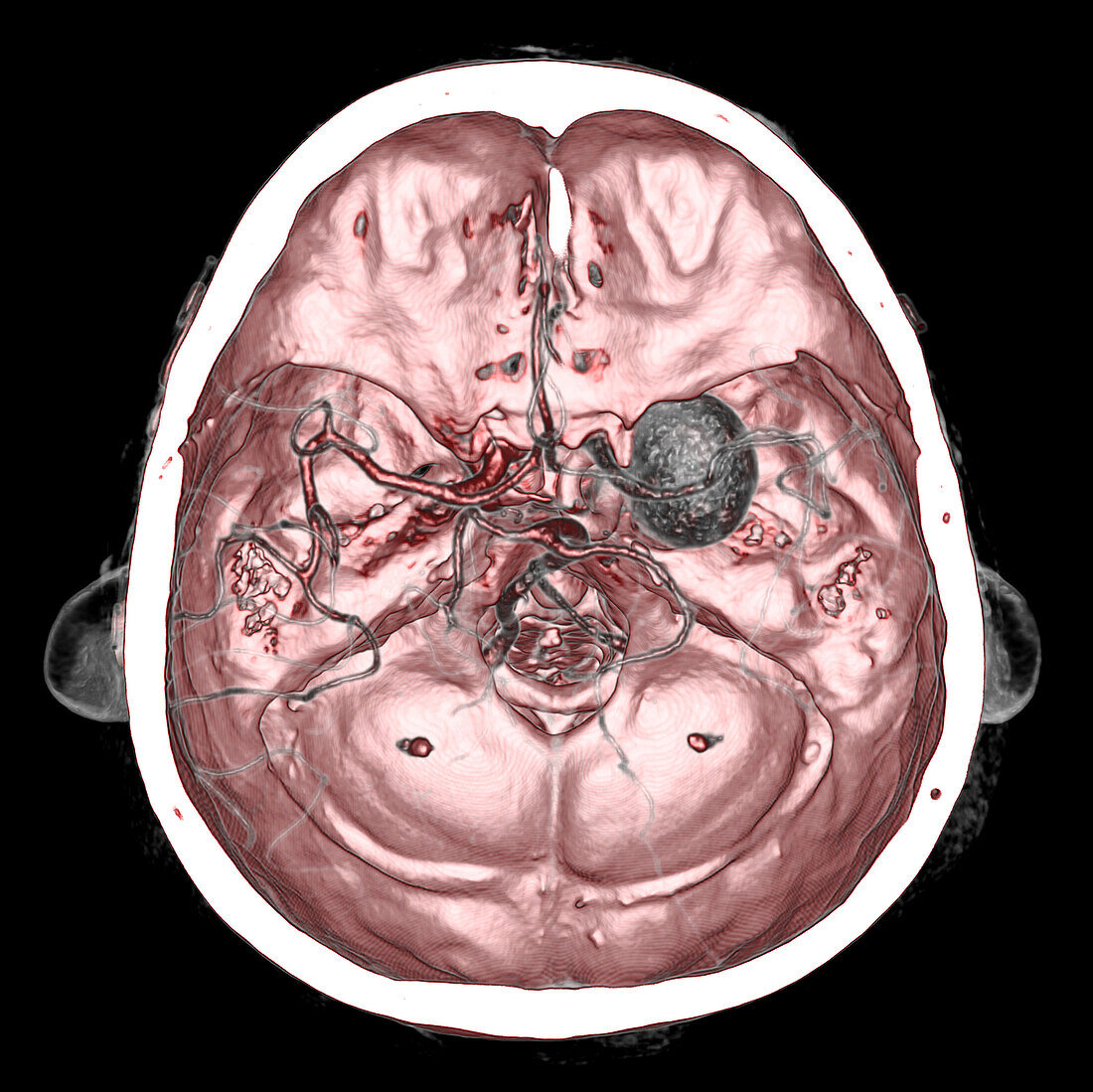 Intracranial aneurysm, CT angiography