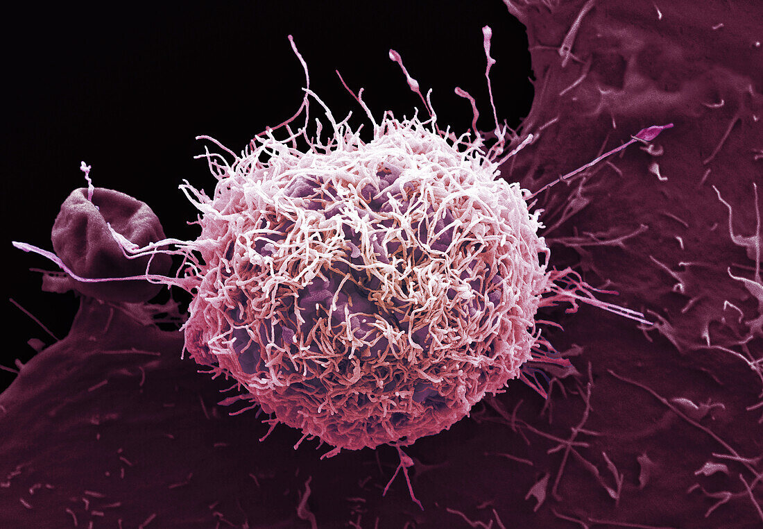 Cervical cancer cells, SEM