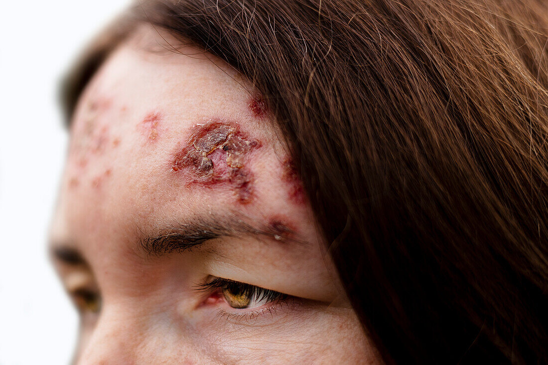 Basal cell carcinoma on a patient's forehead