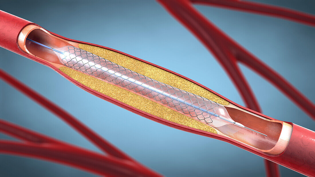 Stent, illustration